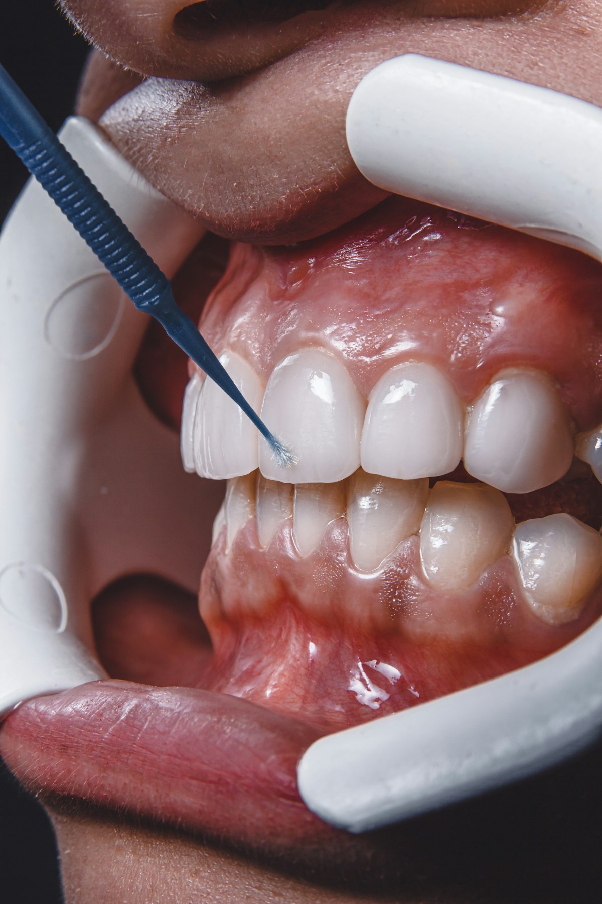 A close view of teeth and gums during an examination
