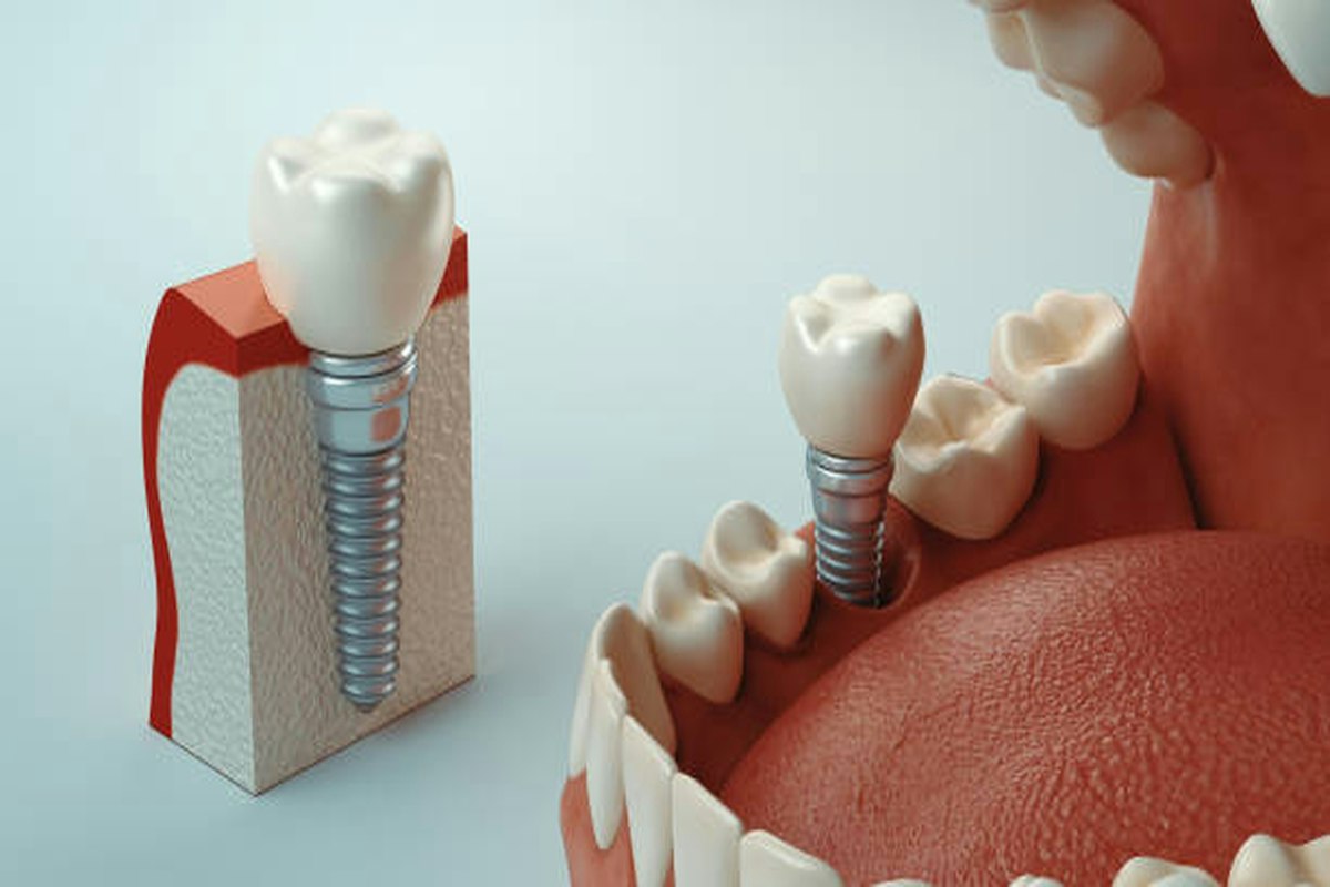 A model of a dental implant beside natural teeth